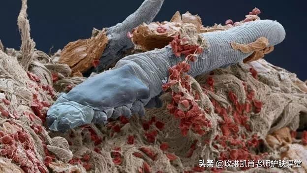 全身被螨虫咬怎么解决,人被螨虫感染了是什么症状