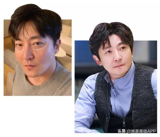 眼袋是不是只有手术才能去除,手术去除眼袋与激光去眼袋哪个好