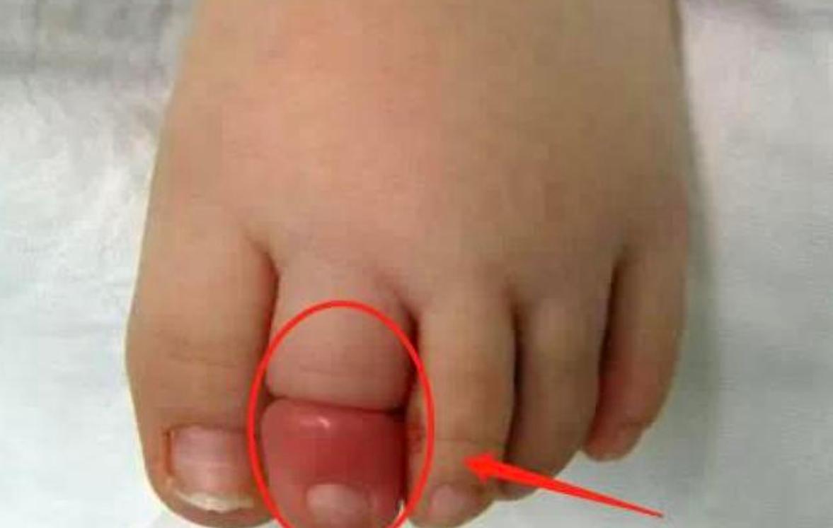 “妈妈，我的脚进虫子了”，宝妈赶紧上医院，医生：还好来得早