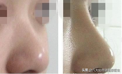 面部一枝花全靠鼻子当家,鼻子一针玻尿酸效果图