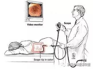 做肠镜到底是种什么体验？作为医生，我用亲身经历一次说个清楚