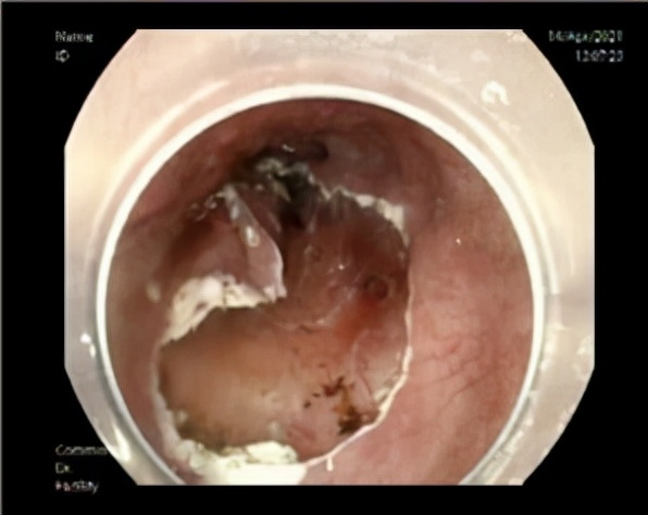 容易忽视的症状有哪些,最容易忽视的三种癌