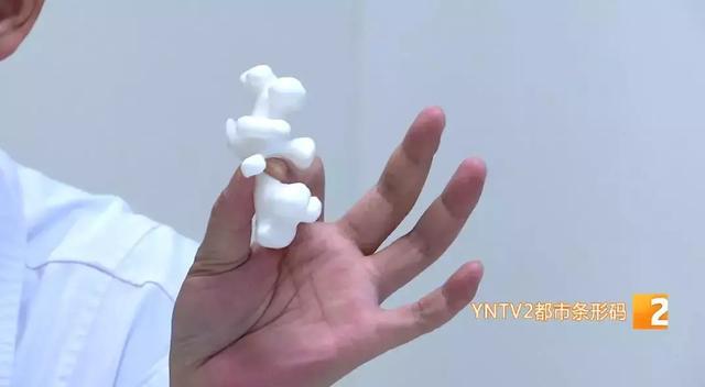 双肾多发结石取出2000多颗,史上最大手术取出肾结石