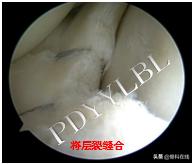 半月板修复视频教程,半月板术后修复
