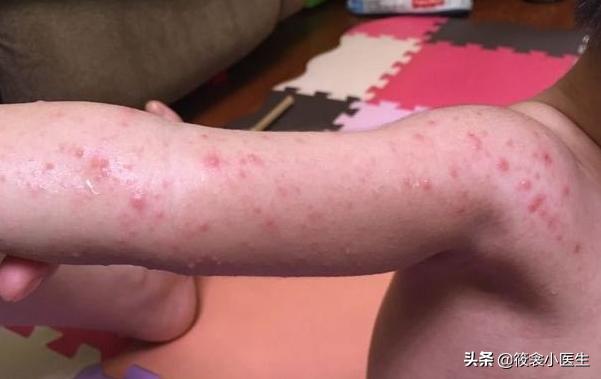 手足口病容易和哪些病混淆,儿科医生手足口病