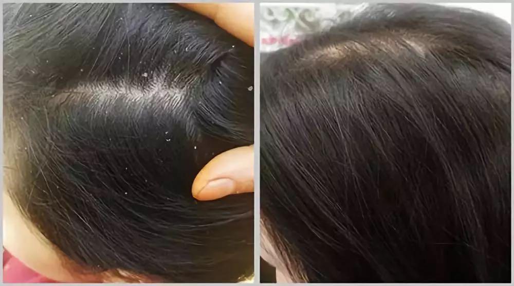 代替海飞丝洗发水,海飞丝洗发水和潘婷洗发水哪种好