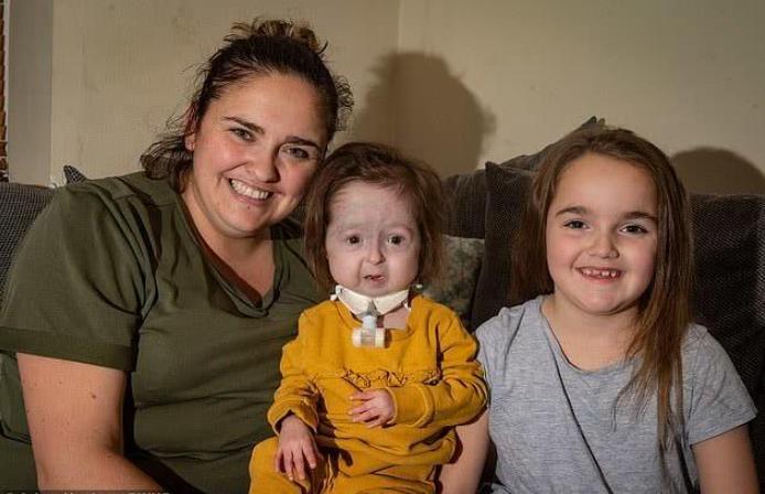 2岁女孩基因突变长得像80岁老人,2个孩子患罕见遗传病