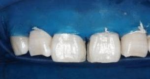 门牙缝可以补吗,门牙有缝怎么办如何补救