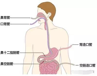 留置胃管的护理记录怎么写,出院后胃管护理宣教