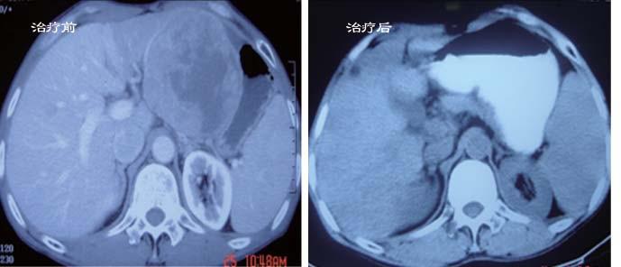 肝癌肝内转移带瘤生存成功案例,肝癌转移肺上多个结节咋治
