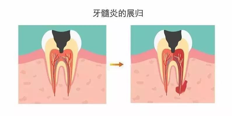 牙髓炎自愈的真实经历,牙髓炎自愈的真实经历是什么