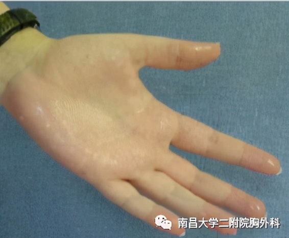 手汗症选哪个医院,手汗症大学科普