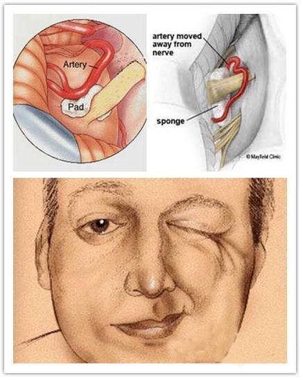 中医治面肌痉挛,面肌痉挛的图片