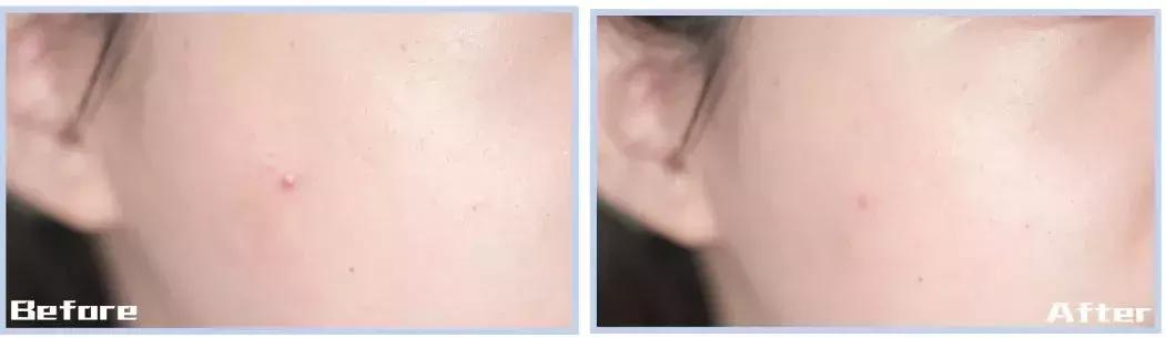 想要脱毛用什么最好,opt冰点脱毛仪器祛斑