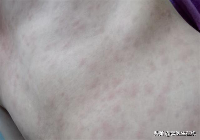 错把艾滋病当皮肤病怎么办,不要错把艾滋病当成皮肤病