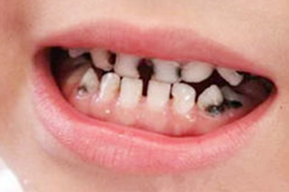 宝宝牙齿腐蚀没了还发黑,宝宝牙齿黄腐蚀