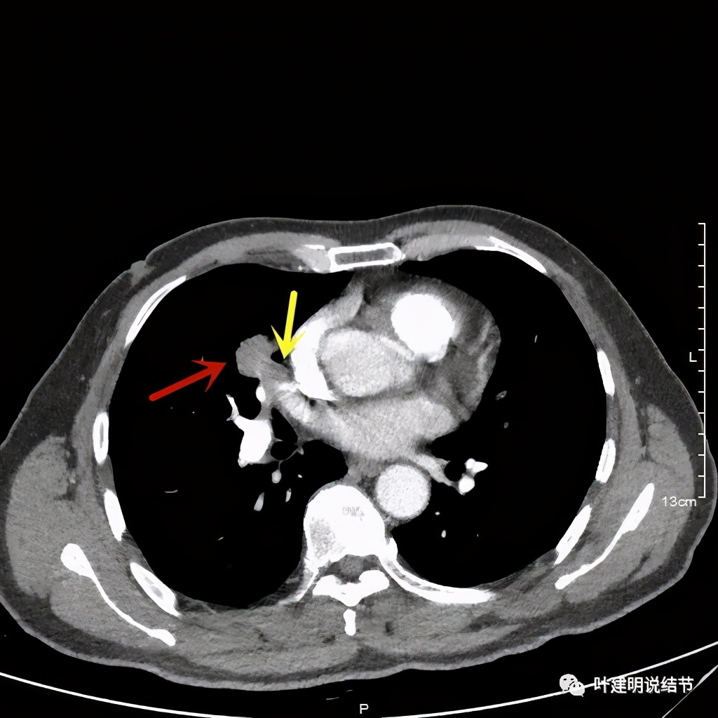 实性结节影要不要紧,实性结节穿刺活检为良性