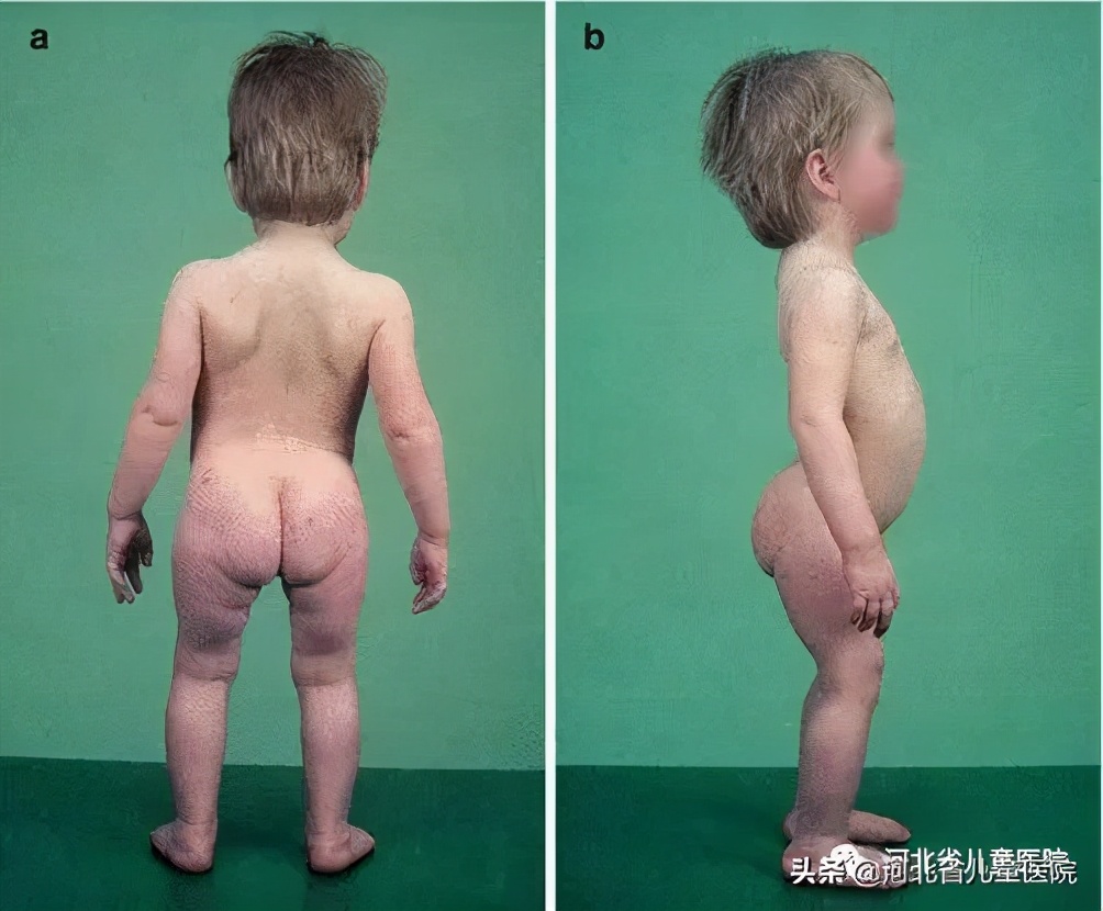 腿纹不对称家长千万别忽视,腿纹深浅不一样算不对称吗