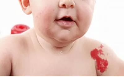高频电凝微创术治疗血管瘤的危害,婴儿背部血管瘤不治疗有什么危害