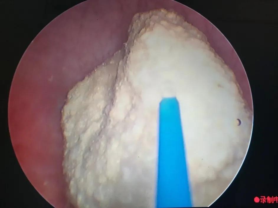 腹腔镜手术取节育环,节育环取出手术