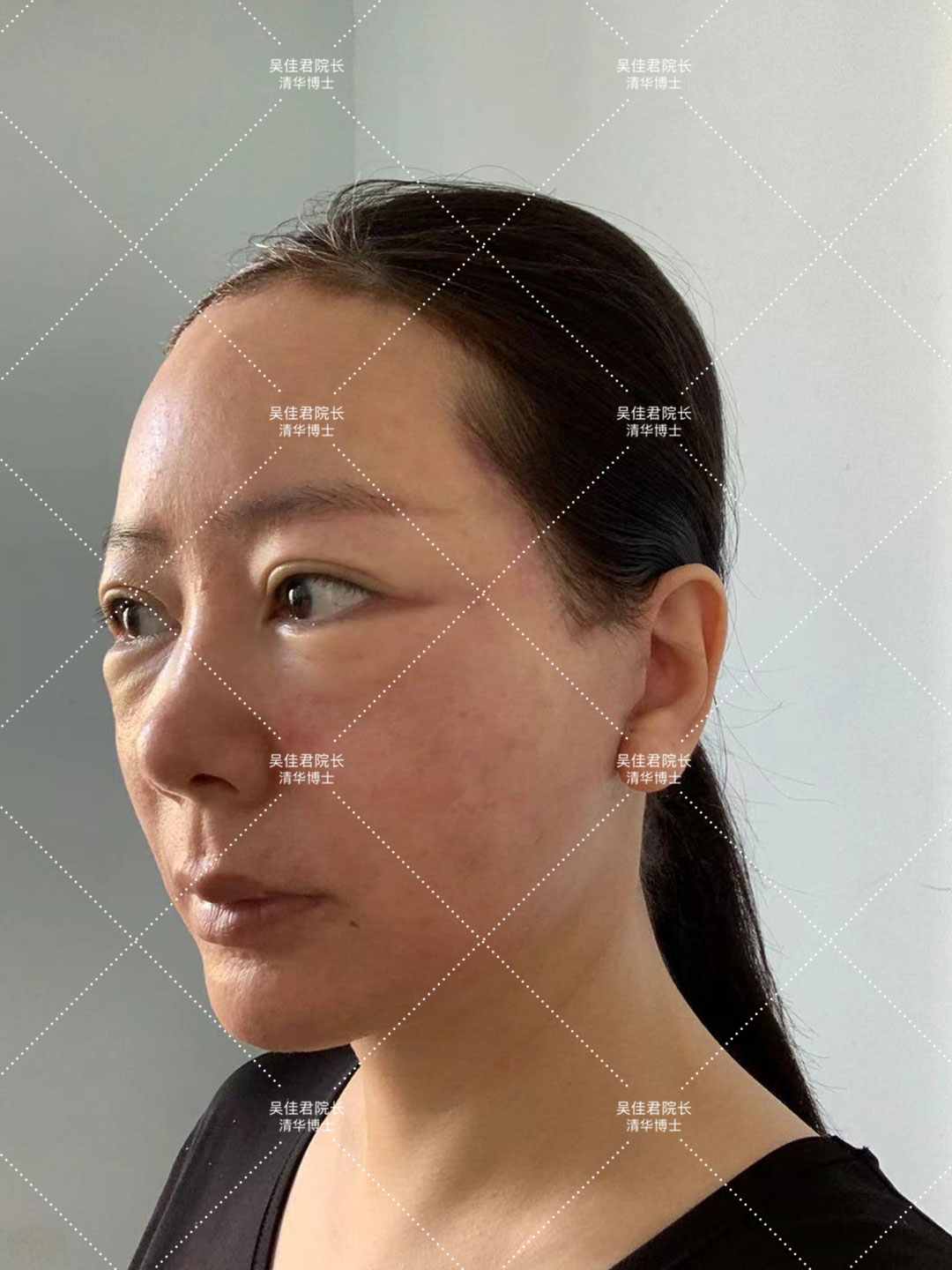 大拉皮术后50天真实感受,拉皮手术5年之后的变化