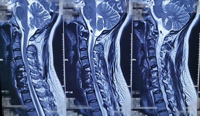 颈椎病压迫神经怎么手术治疗,神经根型颈椎病保守还是手术治疗