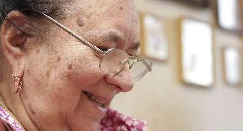 老年斑的消除方法这几招非常有效,哪些原因导致长老年斑