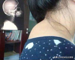 富贵包怎么消除最好方子,富贵包怎么消除视频教学