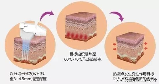 超声刀做了会让脸饱满吗,超声刀做后感触