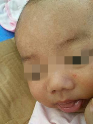 皮肤的小白点怎么解决,皮肤上小白点很痒图片