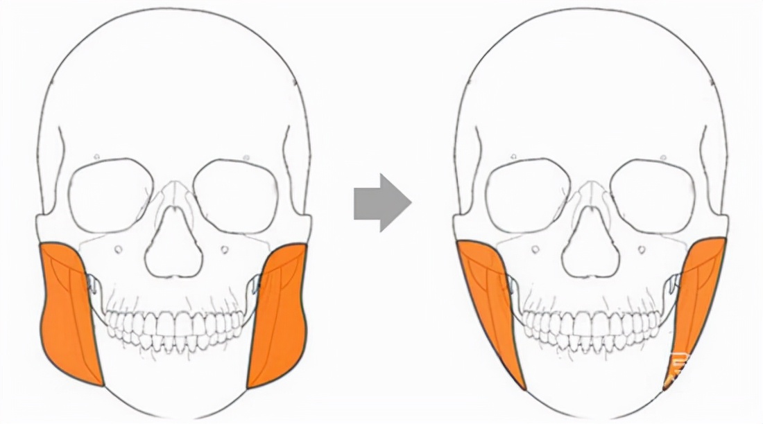 缺牙长期一侧咀嚼嘴巴倾斜,缺牙对咀嚼的影响