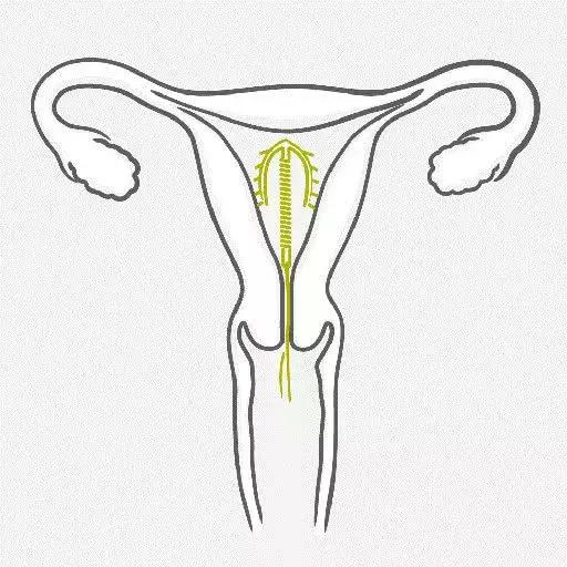 哺乳期妈妈纯孕激素疗法,哺乳期不避孕的条件
