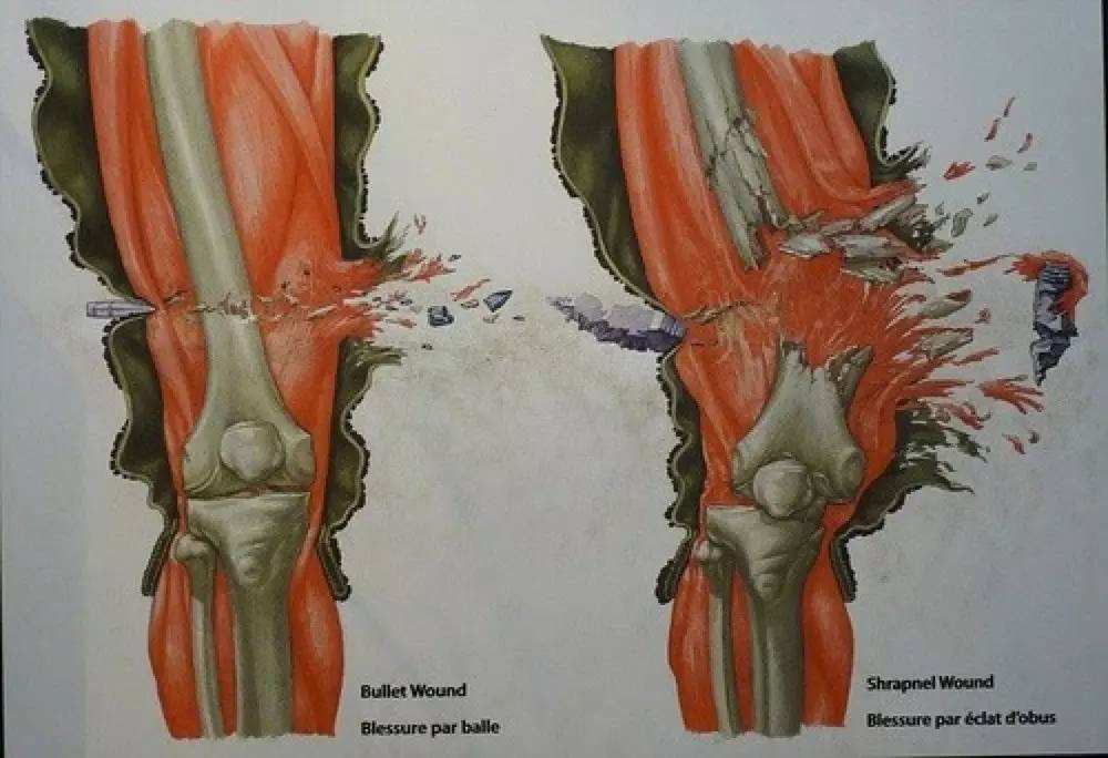 *弹子**那么小，打在人身上致人死亡的原理是什么？
