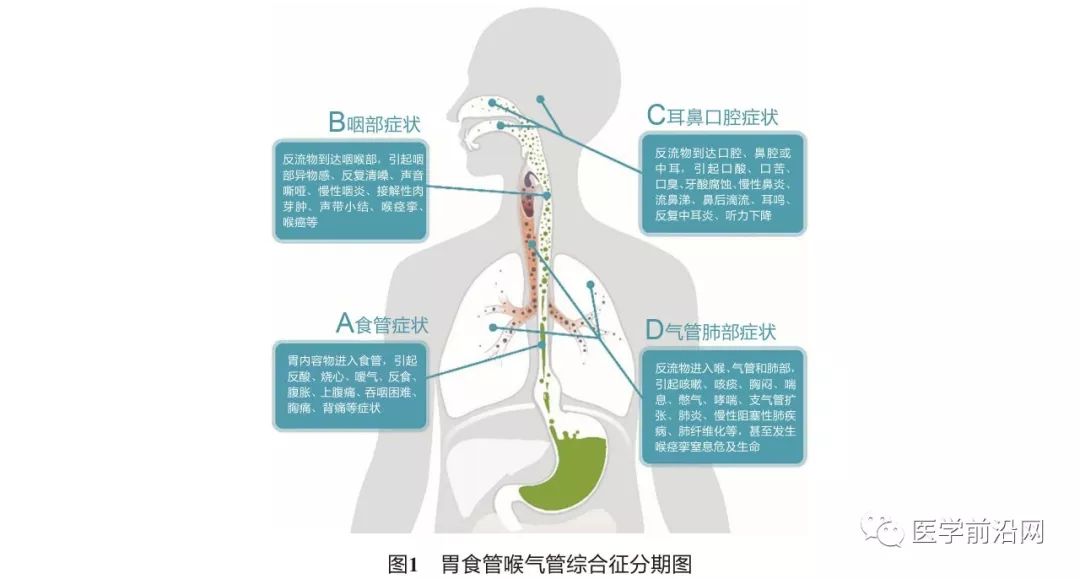 胃食管反流病误诊急性冠脉综合征,胃食管反流性咽炎会引起咳嗽吗