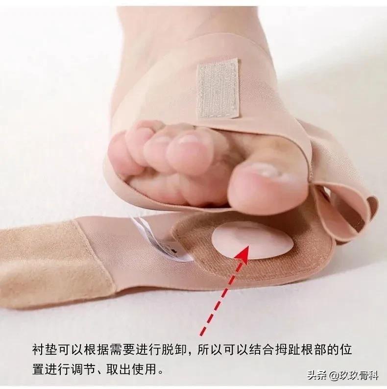 女人的烦恼大全,女朋友有拇外翻怎么办