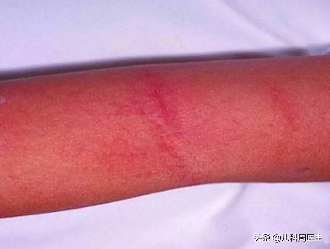 孩子热疹有什么好办法,反复发热有没有可能是幼儿急疹