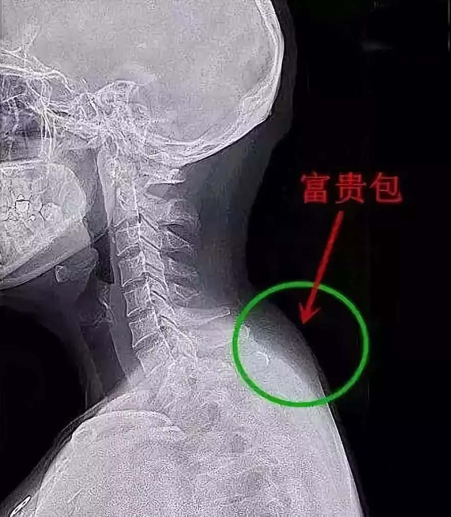 富贵包往往不是真的富贵包,富贵包的形成原因和危害