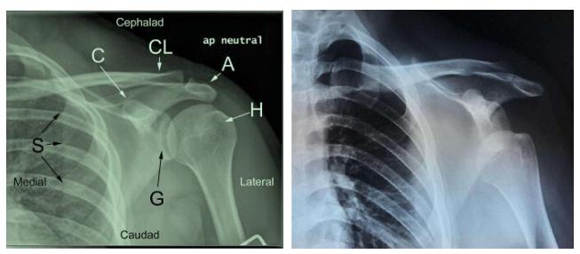 习惯性肩关节脱臼如何改善,肩关节脱位容易形成习惯性脱位吗
