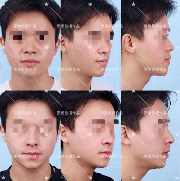 为什么不建议打眉弓针呢,为什么不建议假体隆鼻