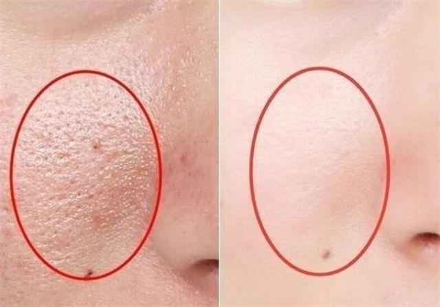 男生毛孔粗大毛孔粗糙怎么办,毛孔粗大怎么办教你一招收缩毛孔