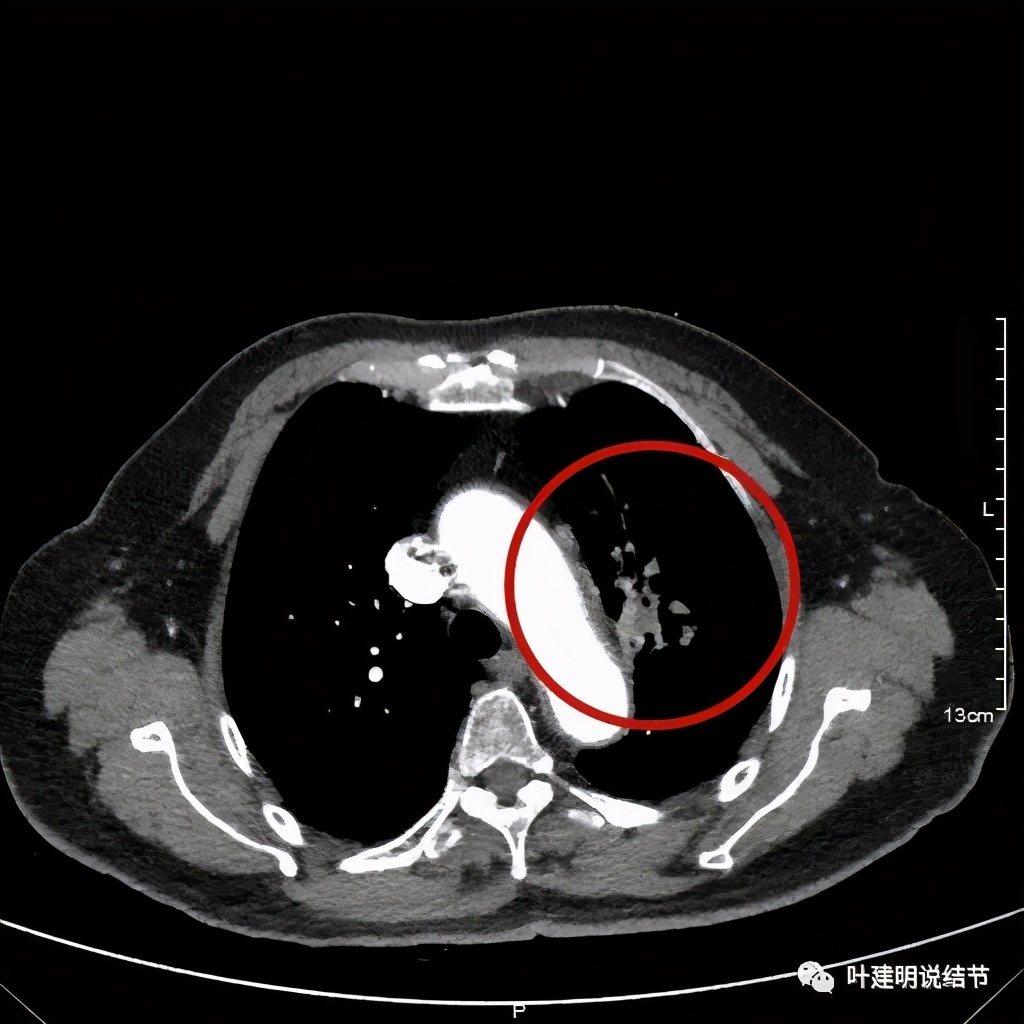 卡瑞利珠单抗治疗肺鳞癌有用吗,特瑞普利单抗对鳞癌治疗有效吗