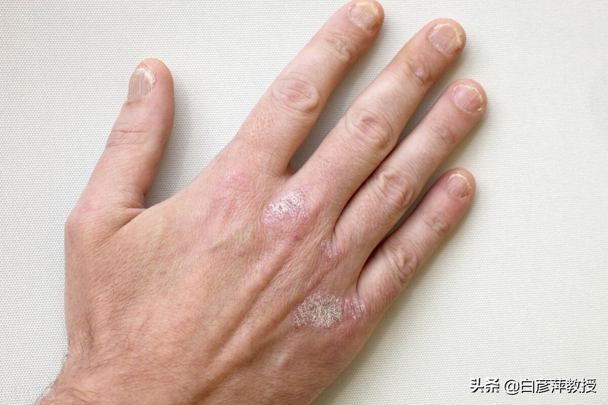 灰指甲是灰色的吗？灰指甲真的会传染吗？皮肤科医生告诉你