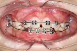 8岁的孩子能做牙齿矫正吗,7岁孩子矫正牙齿早吗