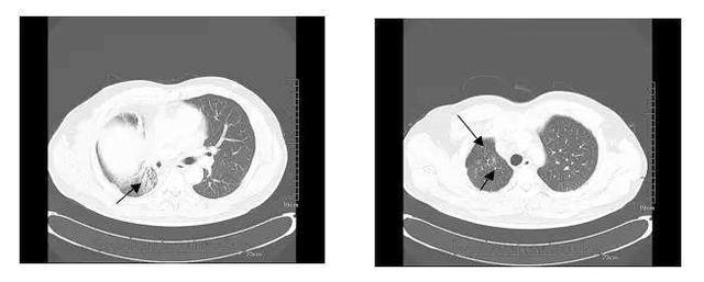 乳腺癌恶性肿瘤18厘米局部晚期,乳腺癌2个月进展至瘤体3厘米左右