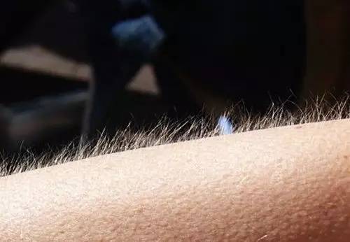 激光脱唇毛真实测评,去唇毛前后对比