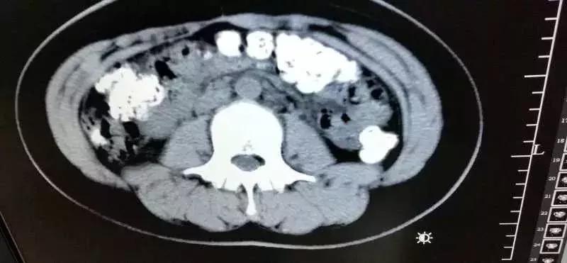14岁女孩肚子一阵阵疼怎么回事,14岁女孩肚子疼该怎么检查