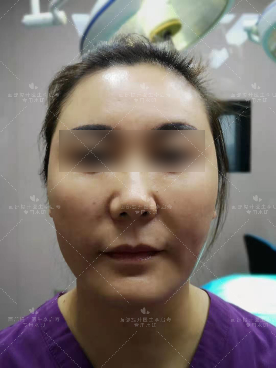 40岁做了线雕的前后图片,40岁以上法令纹下垂医美