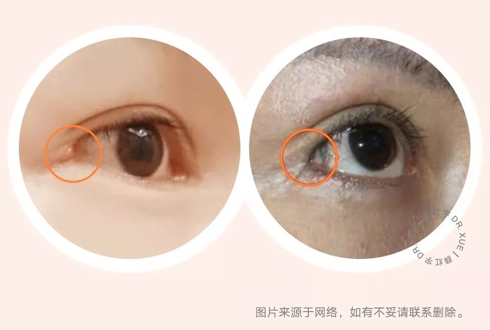 要不要开下眼睑,要不要开内眦赘皮