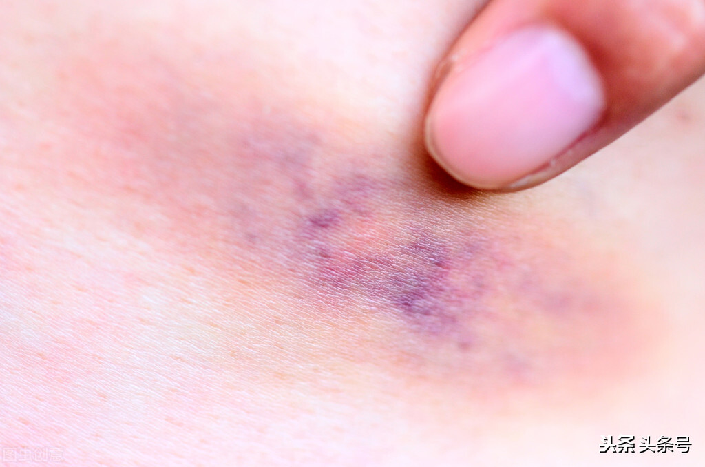 我摔得青紫一片,他说是牛仔裤褪色,这样的男人还能要吗?