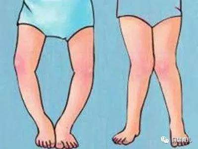 孩子学步最佳年龄,孩子x型腿怎么训练矫正